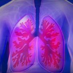Mesotelioma: nuovo studio conferma vertiginoso aumento negli USA